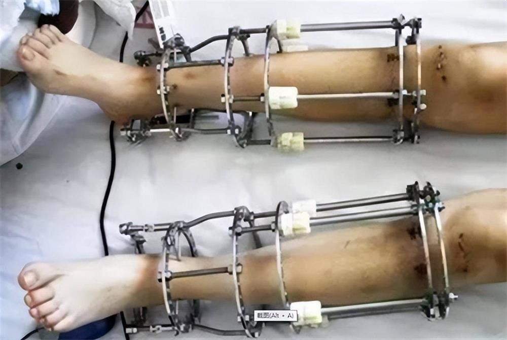 Chàng trai chi nửa tỷ để tăng chiều cao thêm 7cm, cái kết khiến ai cũng sợ hãi-3