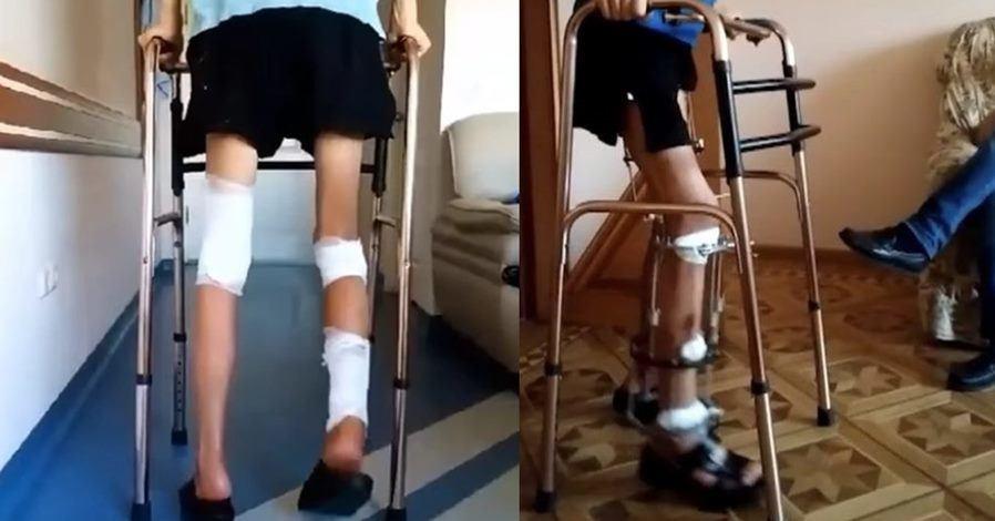 Chàng trai chi nửa tỷ để tăng chiều cao thêm 7cm, cái kết khiến ai cũng sợ hãi-4