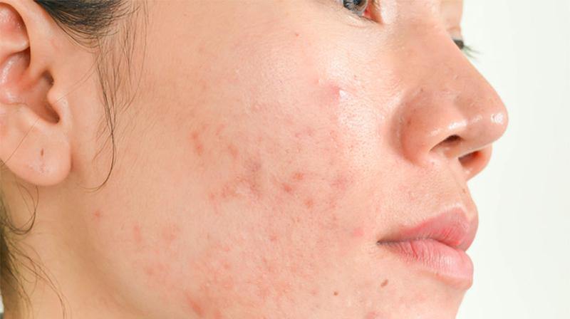 6 thói quen chăm sóc da có thể khiến mụn nổi lên nhiều hơn bất kể tuổi tác-1