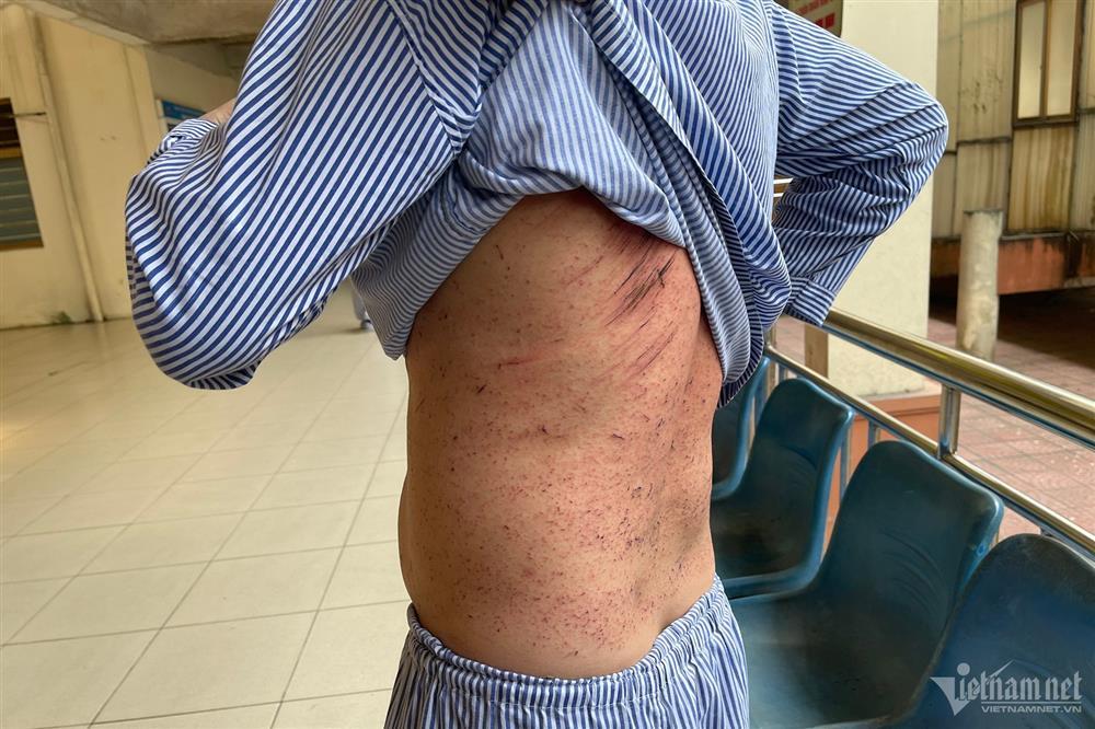 7 công nhân bị thương vụ cháy khí metan: Chúng tôi bị hất văng đi sau tiếng nổ-4