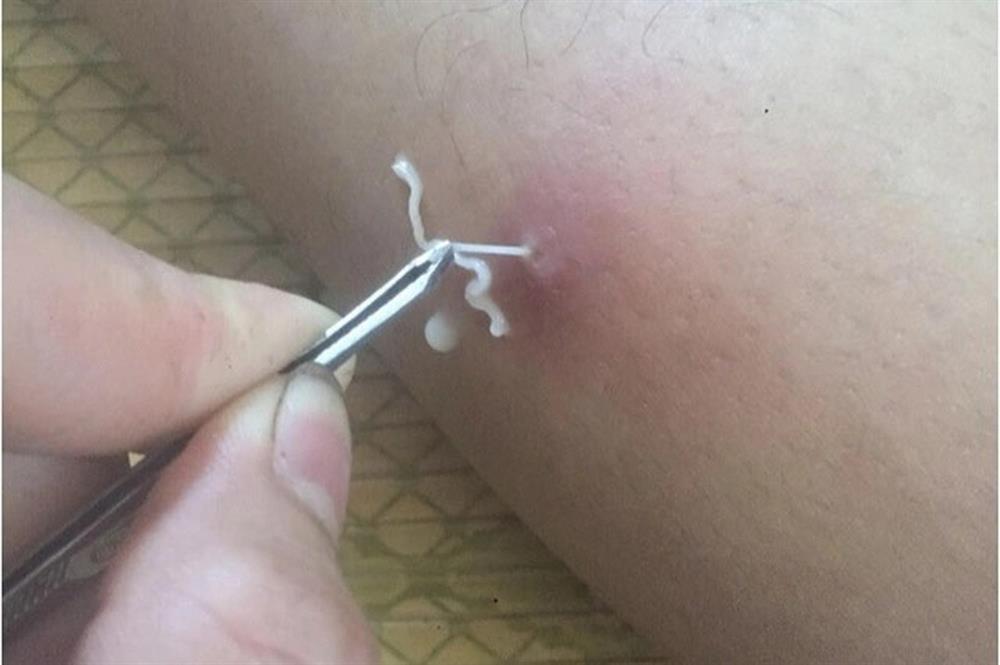 Giun lúc nhúc trong người vì ăn ếch, cá theo kiểu này-1