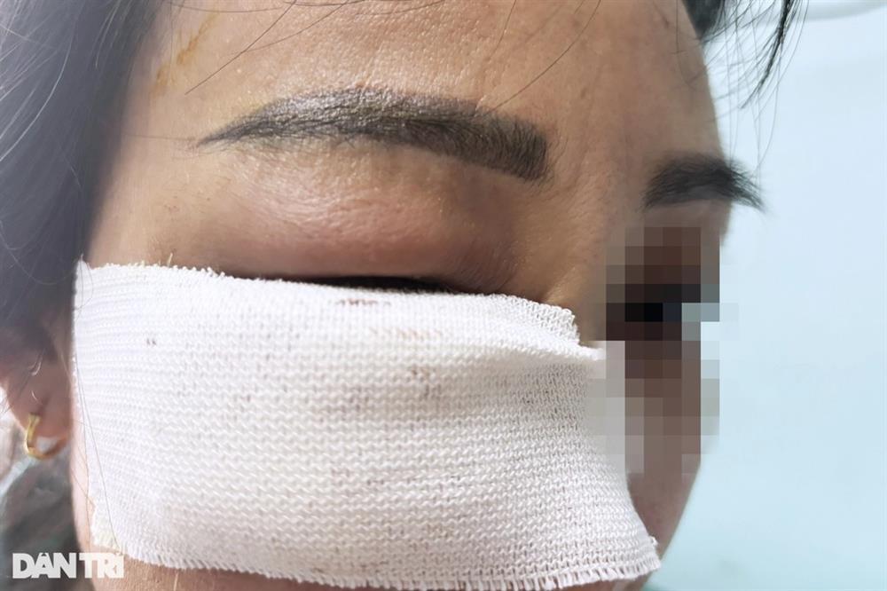 Đi tiêm tan filler ở thẩm mỹ viện: Cẩn thận lành thành què-1