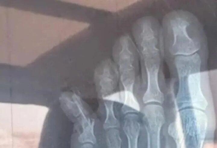 Tức điên khi kèm con học, người mẹ đá tường gãy cả ngón chân-2