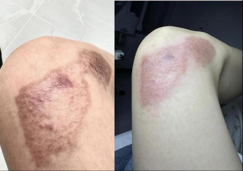 Ngọc Trinh điều trị những vết tích do tai nạn mô tô để lại-2