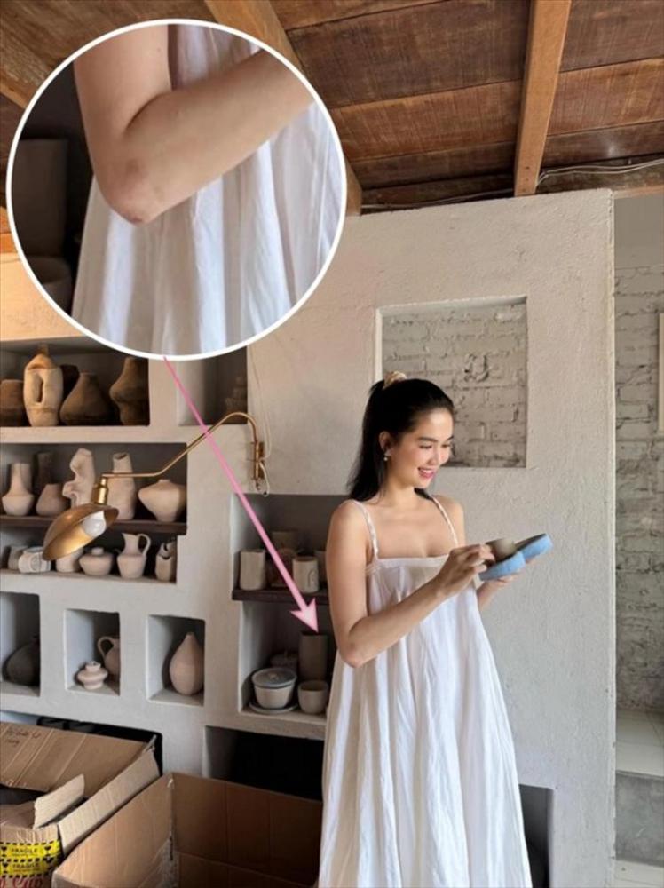 Ngọc Trinh điều trị những vết tích do tai nạn mô tô để lại-3