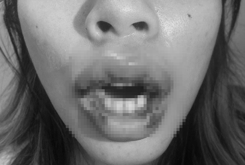 Cô gái trẻ bị biến dạng môi, lở loét chảy mủ vì bác sĩ mới tốt nghiệp THPT-1