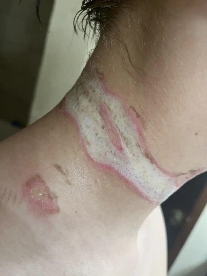 Vòng cổ khiến thiếu niên bị điện giật suýt chết, cổ mang sẹo hình dây chuyền-2