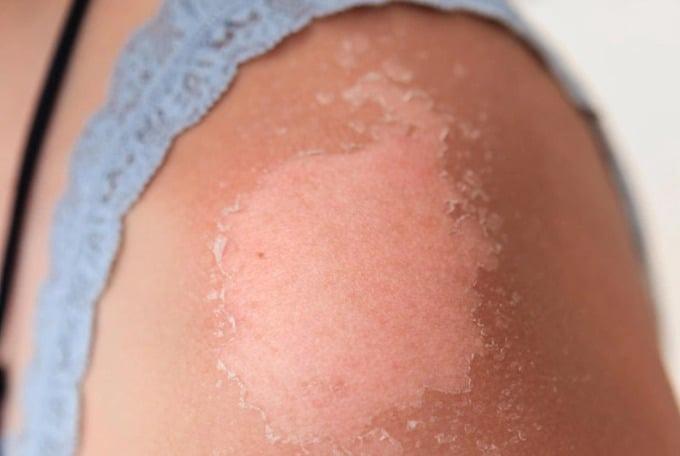 Cách phục hồi làm dịu vết cháy nắng ở nam giới-1