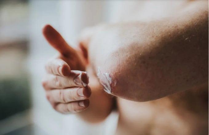 Cách phục hồi làm dịu vết cháy nắng ở nam giới-2