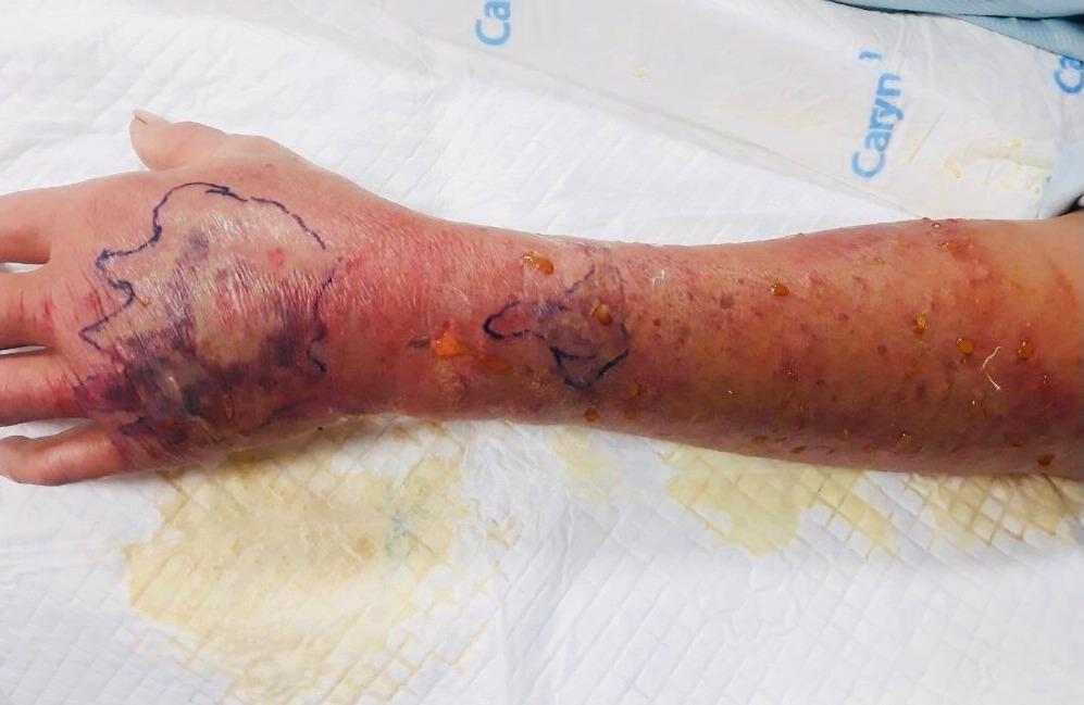 Người đàn ông nhập viện sau khi bị cháu 3 tuổi cắn-1