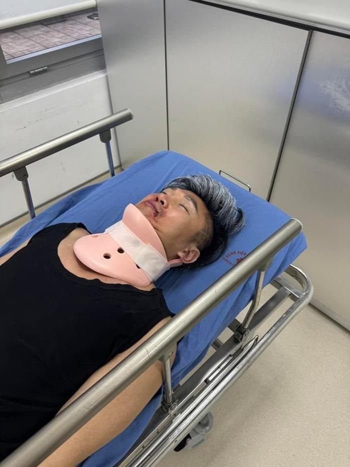 Ca sĩ Du Thiên bị thương nặng, mặt bầm tím phải cấp cứu giờ ra sao?-2