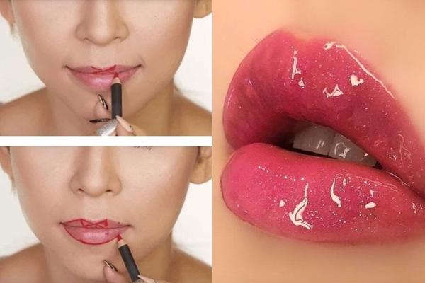 Tiêm filler có an toàn không, bao lâu mới tan hết?-3