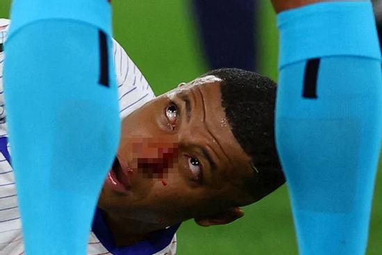 Cận cảnh pha va chạm khiến Mbappe đổ máu, đến thẳng bệnh viện