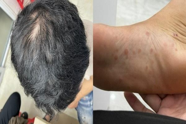 6 vitamin và khoáng chất nếu thiếu hụt gây rụng tóc-2