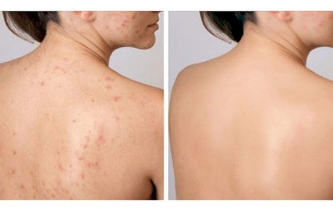 5 tips trị mụn trứng cá không để lại vết thâm trên da-2