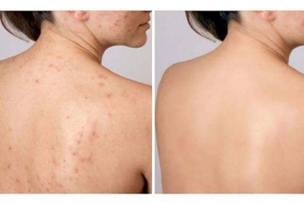 Mặt tan nát sau 3 tuần uống thuốc tránh thai điều trị mụn-3