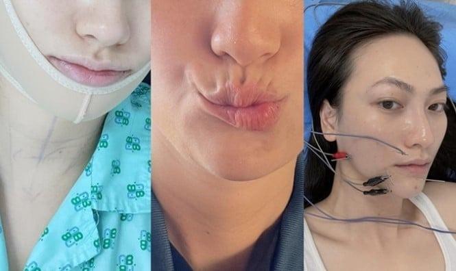Phương Anh Đào 3 năm sau mổ u giáp: Từng méo miệng và sự trở lại rực rỡ-2