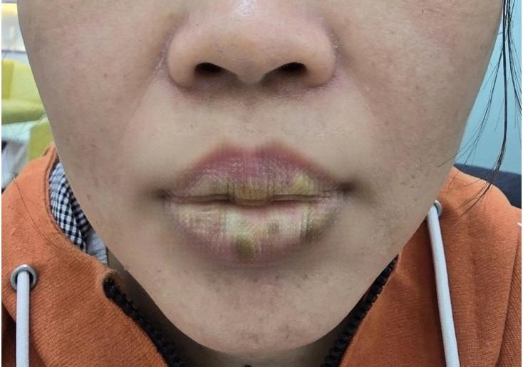 Xăm môi làm đẹp, không ngờ nhập viện khẩn-1