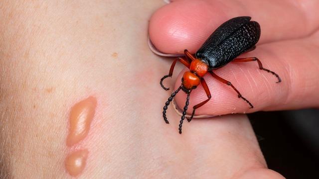 Ăn loại côn trùng được đồn thổi tăng cường sinh lý, người đàn ông đái ra máu, suy thận cấp-1