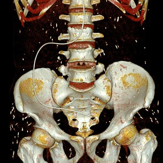 Người đàn ông ở Phú Thọ phát hiện sán ký sinh khắp cơ thể do sai lầm ăn uống, người Việt mắc phải hàng ngày-1
