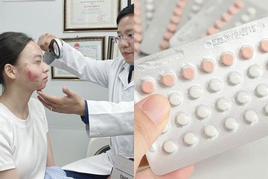 Mặt 'tan nát' sau 3 tuần uống thuốc tránh thai điều trị mụn
