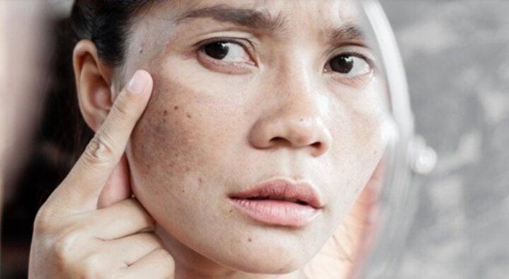 Mách bạn mẹo làm mờ vết đồi mồi trên da nhanh chóng-1