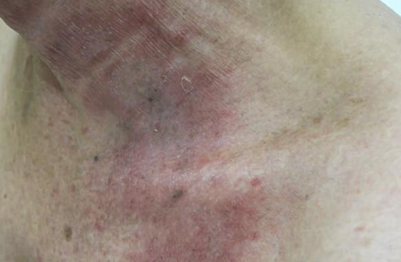 Mùa mưa đến, kiến ba khoang hoành hành, hàng trăm người ở TP.HCM biến dạng da vào viện cầu cứu vì dịch độc-1