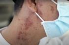 Mùa mưa đến, kiến ba khoang 'hoành hành', hàng trăm người ở TP.HCM biến dạng da vào viện cầu cứu vì dịch độc