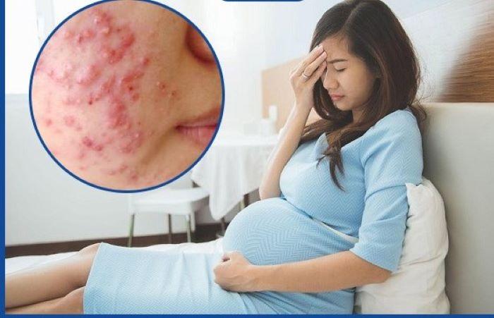 Khắc phục mụn trứng cá ở phụ nữ mang thai-1