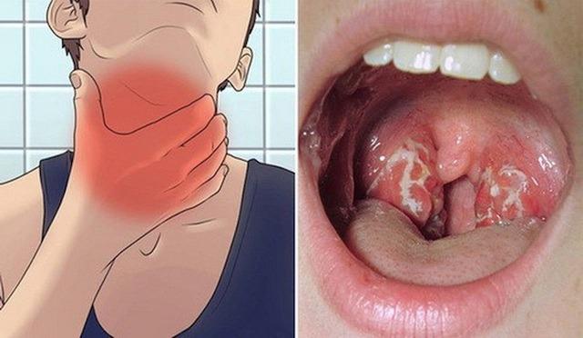 Ai có nguy cơ lây nhiễm bệnh bạch hầu? 3 nhóm người này cần tiêm vaccine bạch hầu càng sớm càng tốt-2