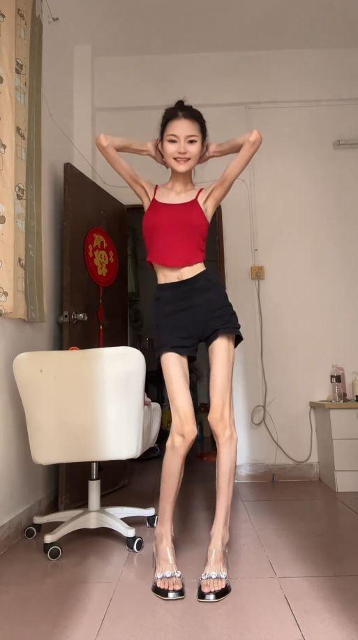 Cô gái cao 1m60, nặng 25kg, thân hình gầy trơ xương nhưng vẫn tiếp tục giảm cân: Bác sĩ cảnh báo đỏ-3