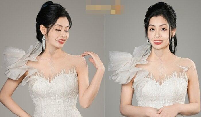 Cuộc sống mới của người phụ nữ từng bị chồng tạt axit để lại vết sẹo hơn 30cm-1