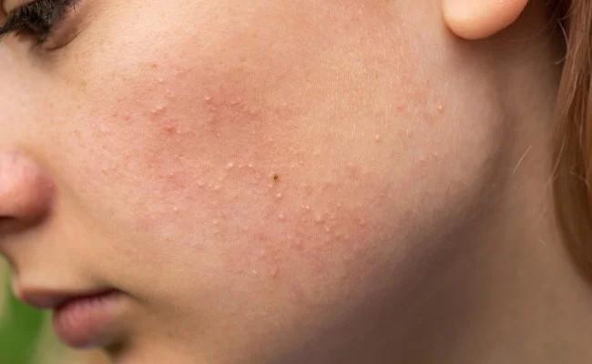 Mụn ẩn có nên nặn không?-1