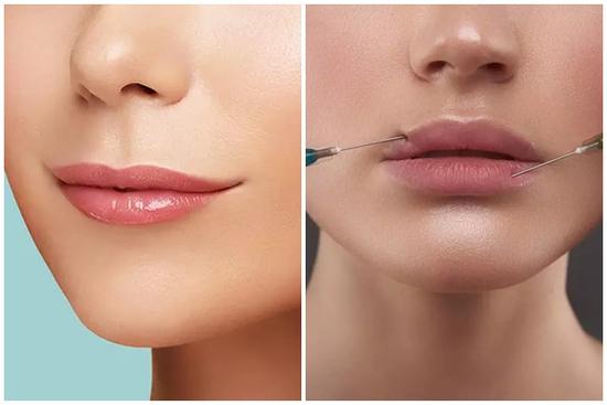 Những lưu ý trước và sau khi tiêm filler môi