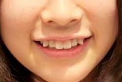 Tại sao rất nhiều người Nhật có hàm răng không đều?