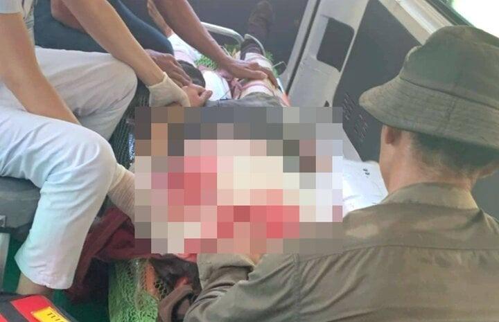 Người phụ nữ bị đá lớn lăn trúng người khi đi làm rừng, chấn thương sọ não-1