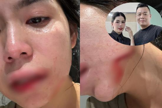 Nóng: Hằng Du Mục công khai toàn bộ hình ảnh bị chồng bạo hành tàn nhẫn, tuyên bố thời điểm ly hôn