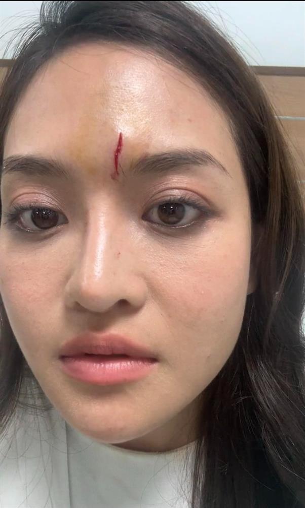 Diễn viên Thùy Anh gặp tai nạn phim trường-2