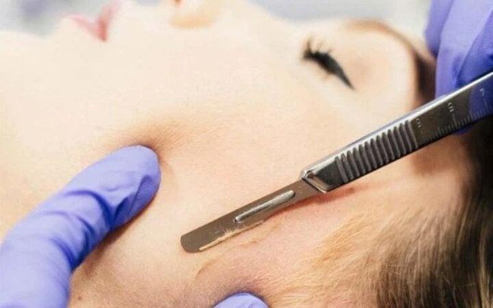 Có nên cạo lông mặt?-1