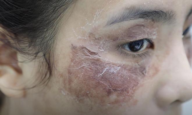 Người phụ nữ ở TPHCM nhập viện sau khi tự peel da tại nhà-2