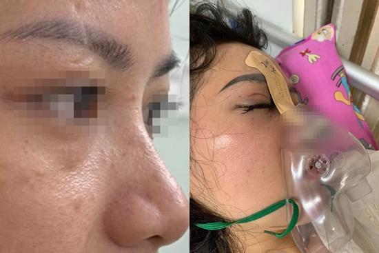 Sốc phản vệ vì tiêm filler mũi