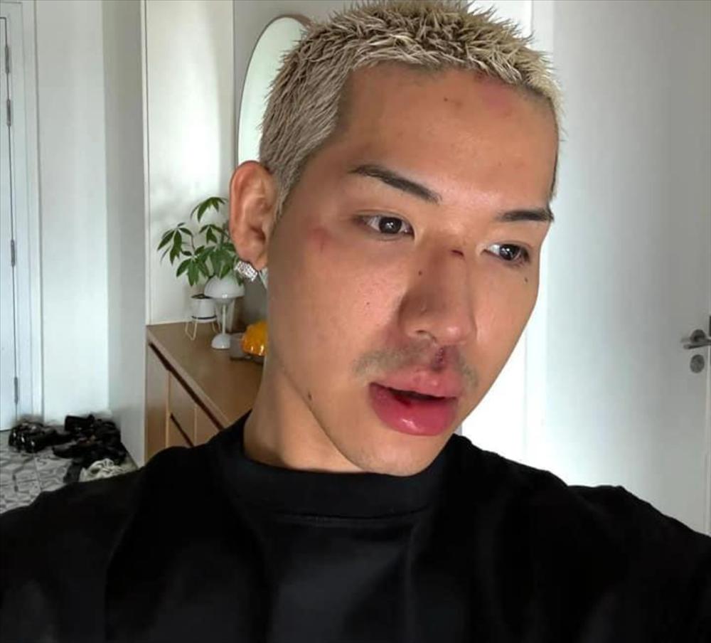 WEAN LE lộ thêm dấu hiệu gây hoang mang sau khi ngất xỉu đập mặt xuống đường-3