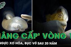 Nâng cấp vòng 1 sau 20 năm, không ngờ túi ngực xơ hóa, bục vỡ biến chứng nặng