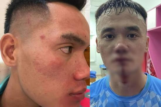2 cầu thủ Hạng Nhất đánh nhau đối mặt án phạt nặng