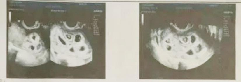 Người mẹ gây xôn xao khi mang 9 bào thai cùng một lúc-1