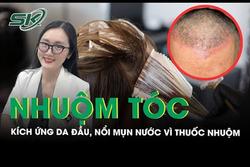 Da đầu ửng đỏ chi chít mụn nước vì dị ứng thuốc nhuộm tóc