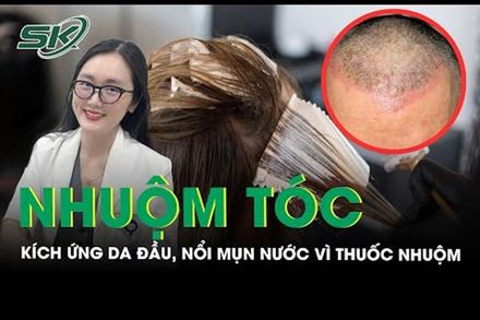 Da đầu ửng đỏ chi chít mụn nước vì dị ứng thuốc nhuộm tóc