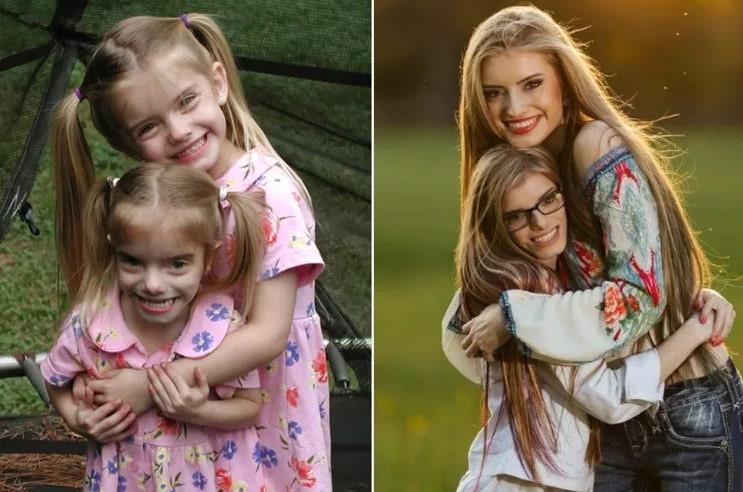 Cuộc sống hiện tại của cặp song sinh chị cao 1m7, em chỉ 1m32-1