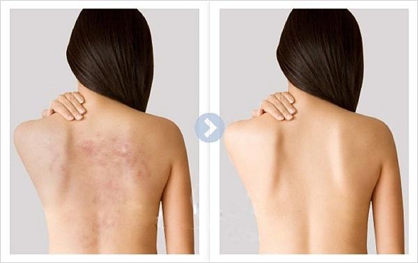 Cách trị mụn lưng bằng muối giúp nàng tự tin diện đồ bơi-3