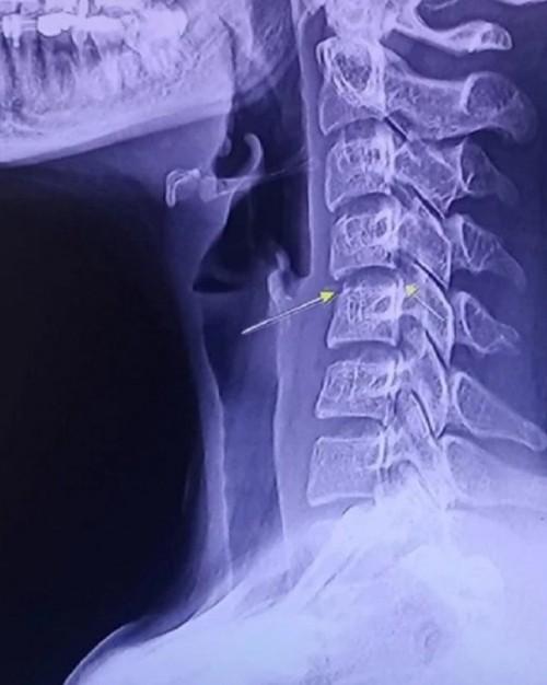 Cảnh báo từ vụ nữ ca sĩ Thái Lan qua đời sau khi đi mát-xa cho đỡ đau lưng-2